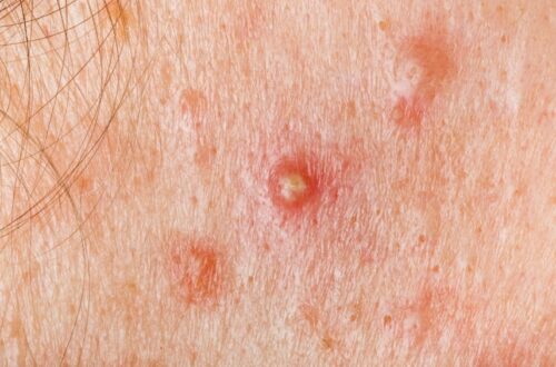 Bye Jerawat Meradang! Ini Manfaat Susu Kefir untuk Perawatan Kulit dari Dalam