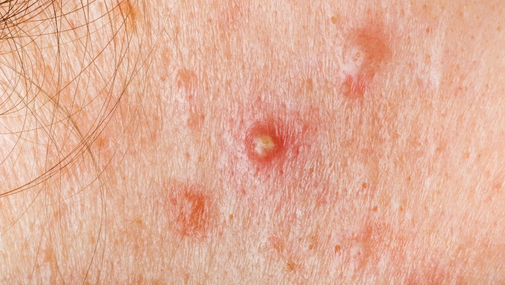 Bye Jerawat Meradang! Ini Manfaat Susu Kefir untuk Perawatan Kulit dari Dalam